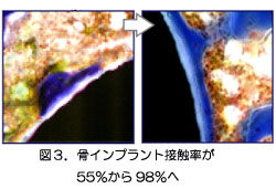 図3・骨インプラント接触率が55%から98%へ